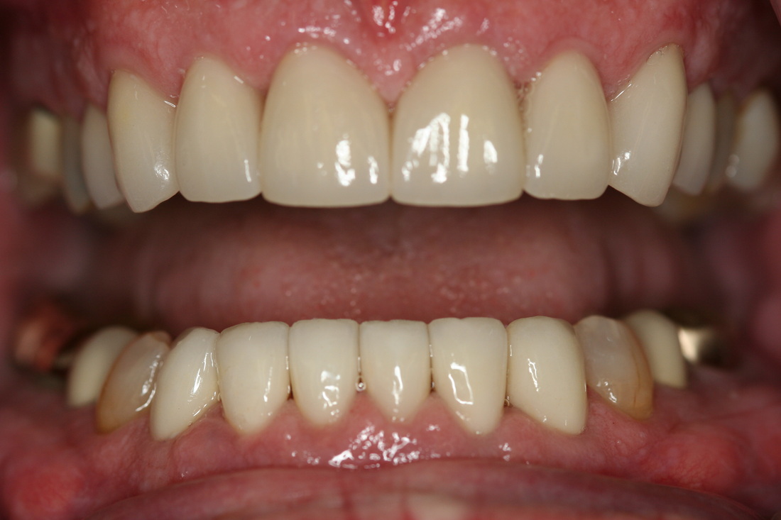 After — Crown restoration — protected and natural-looking tooth