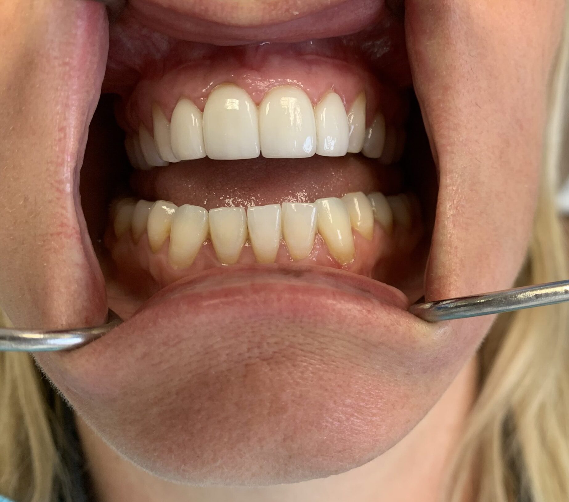 Six anterior crowns placed by Dr. John Olson DDS in Huntington Beach