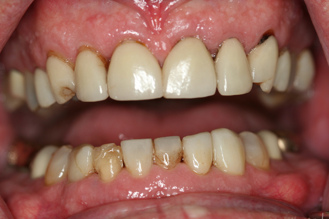 Before — Crown restoration — protected and natural-looking tooth