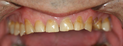 Before crowns — second case