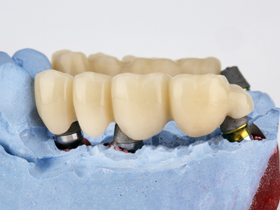 Dental implant restoration diagram — step one