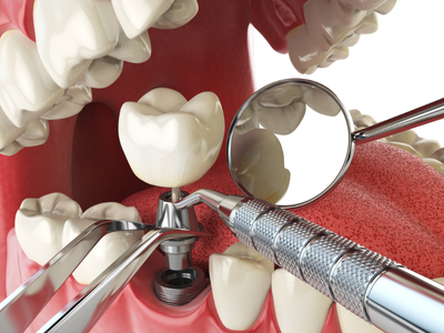 Dental implant restoration diagram — completed restoration