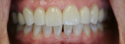 After — Orthodontic treatment — gap and alignment corrected