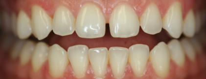 Before — Orthodontic treatment — gap and alignment corrected