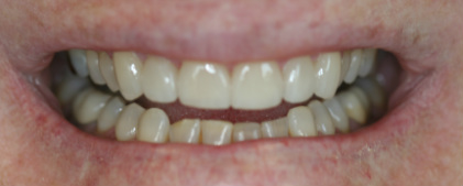 After — Veneer transformation — straighter, whiter smile