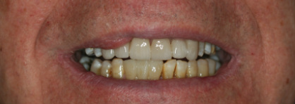 After — Veneer case — corrected chips and discoloration