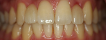 Before — Veneer transformation — straighter, whiter smile
